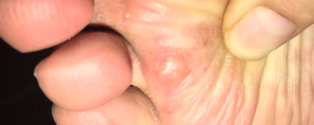水泡能刺破吗?水泡能刺破吗